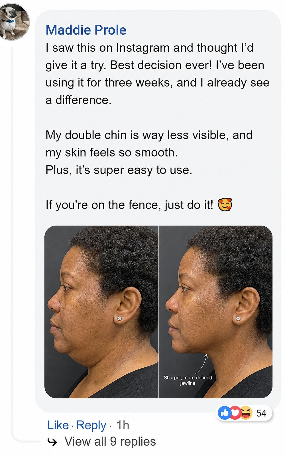 Side-by-side facial profile comparison showing jawline improvement.