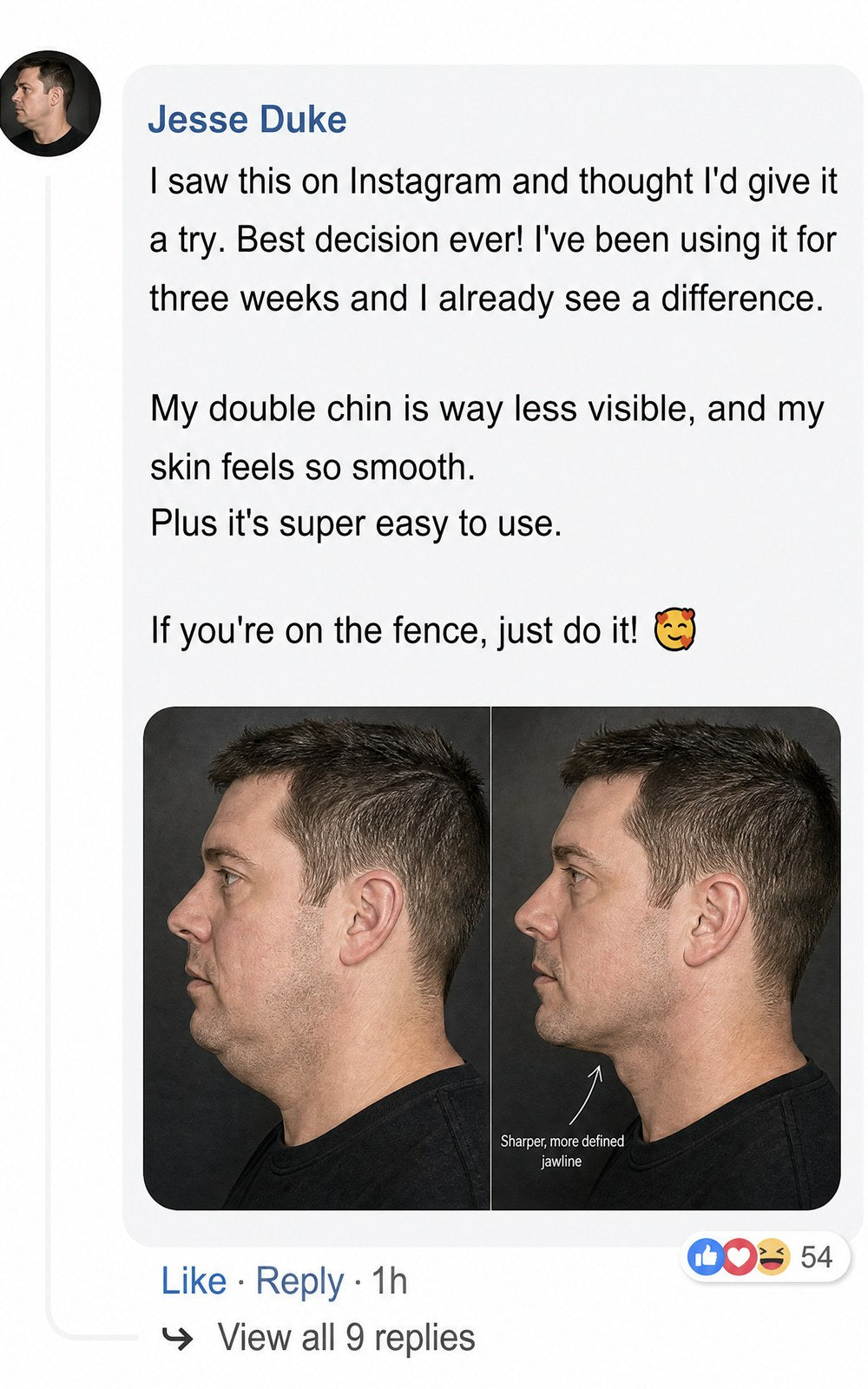 Side-by-side facial profile comparison showing jawline improvement.