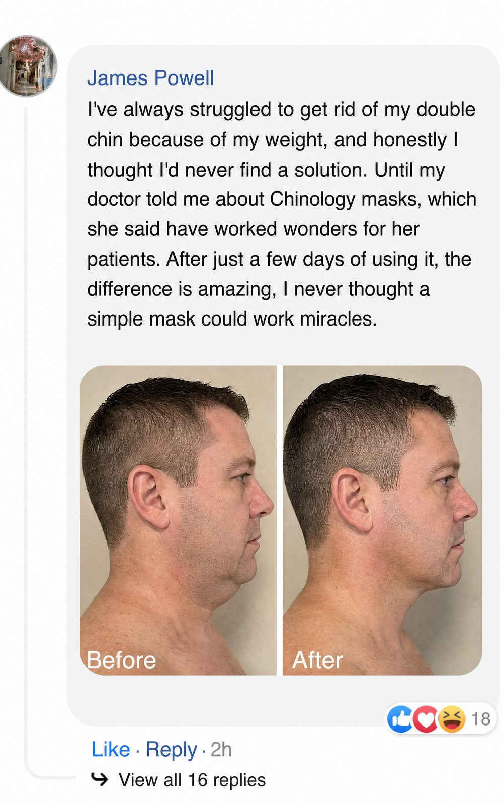 Before and after profile photos showing reduced double chin after using masks.
