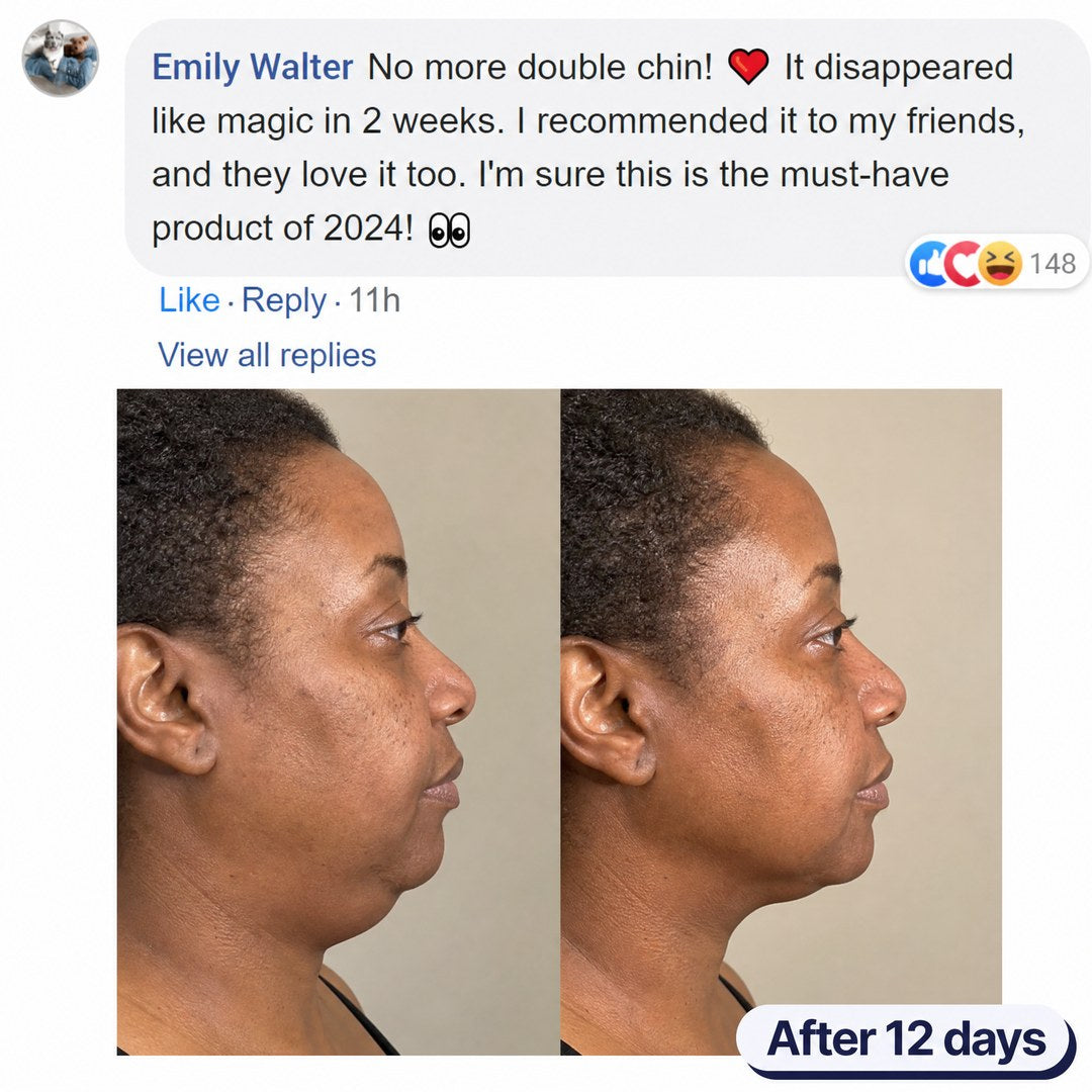 Before and after images of a woman showing reduced chin fullness after 12 days.