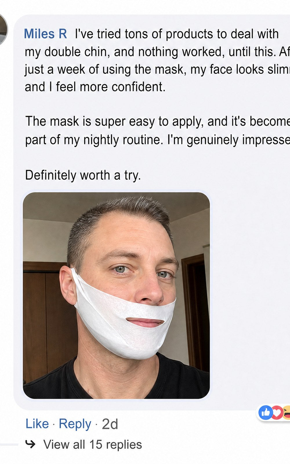 Before and after photos showing visible reduction in double chin.