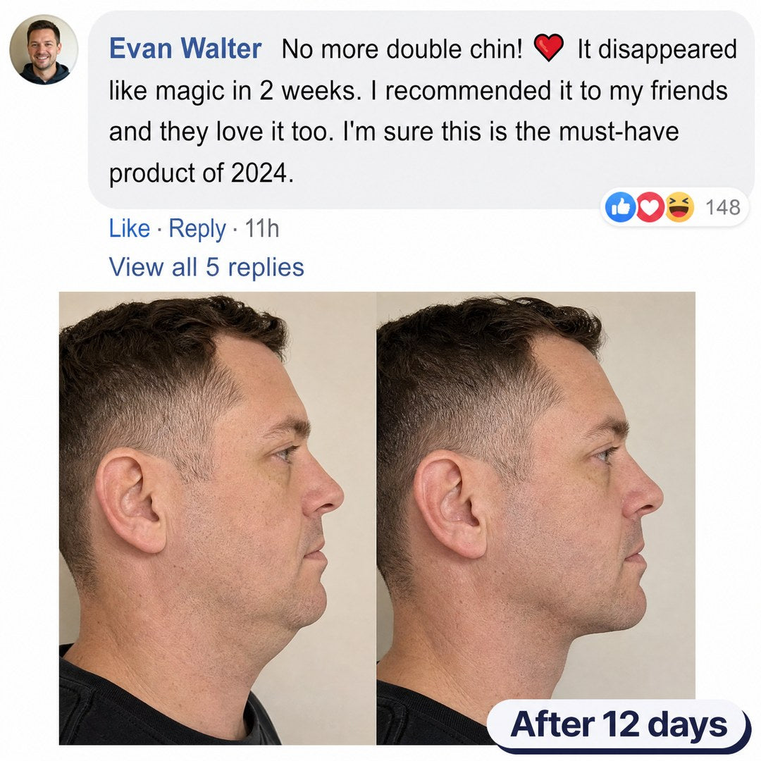 Before and after images of a woman showing reduced chin fullness after 12 days.