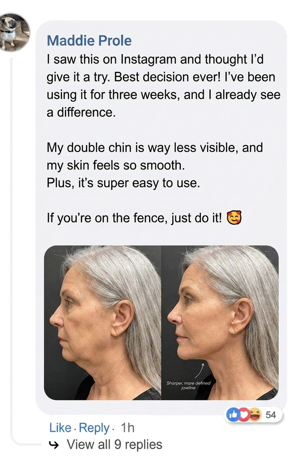 Side-by-side facial profile comparison showing jawline improvement.