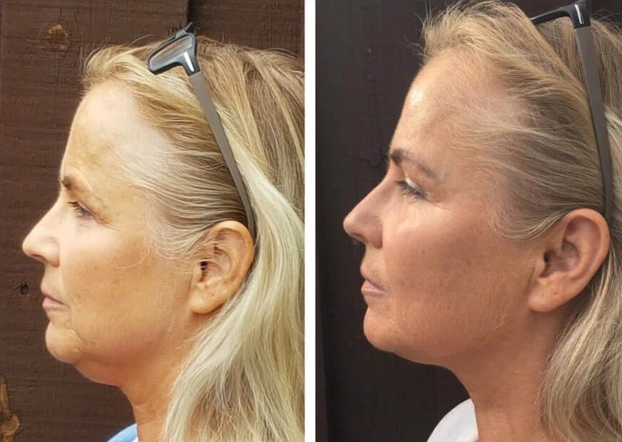 Brand-supplied Chinology before and after photographs; individual results vary